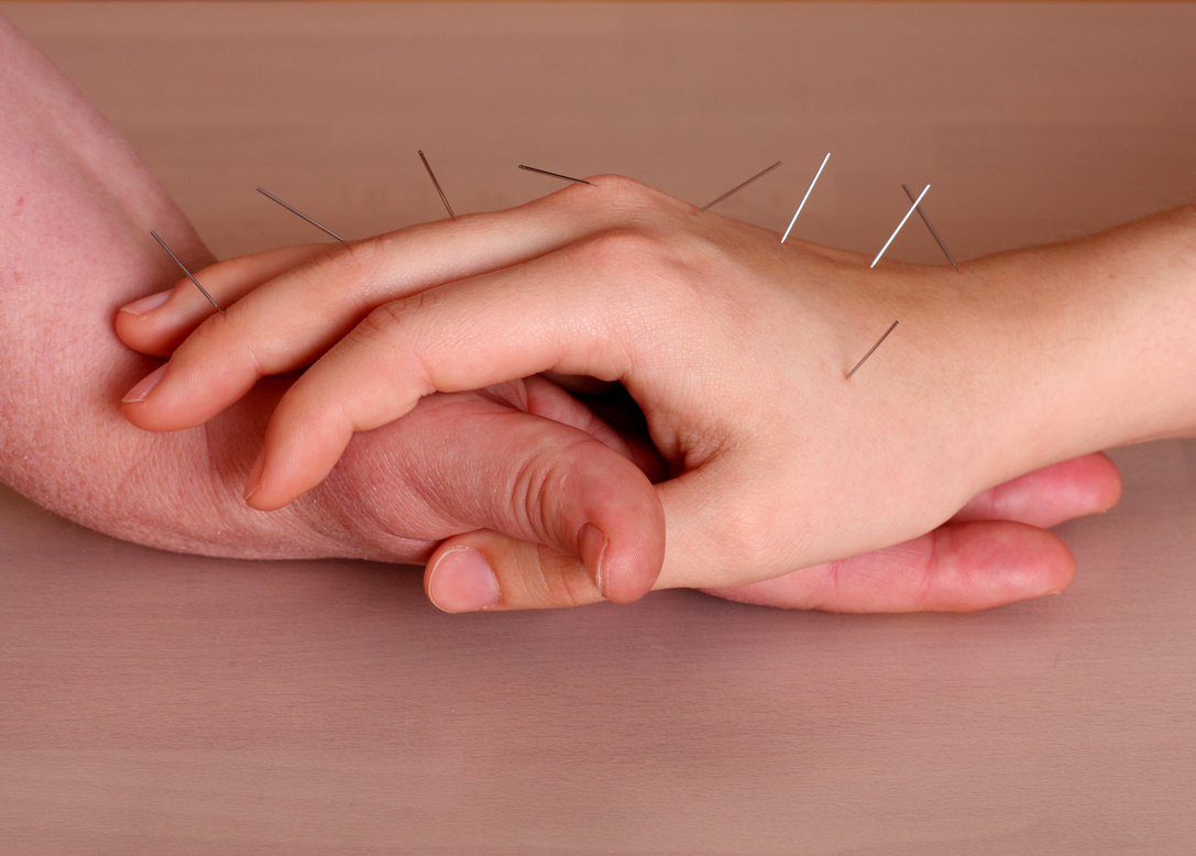 Korean hand acupuncture