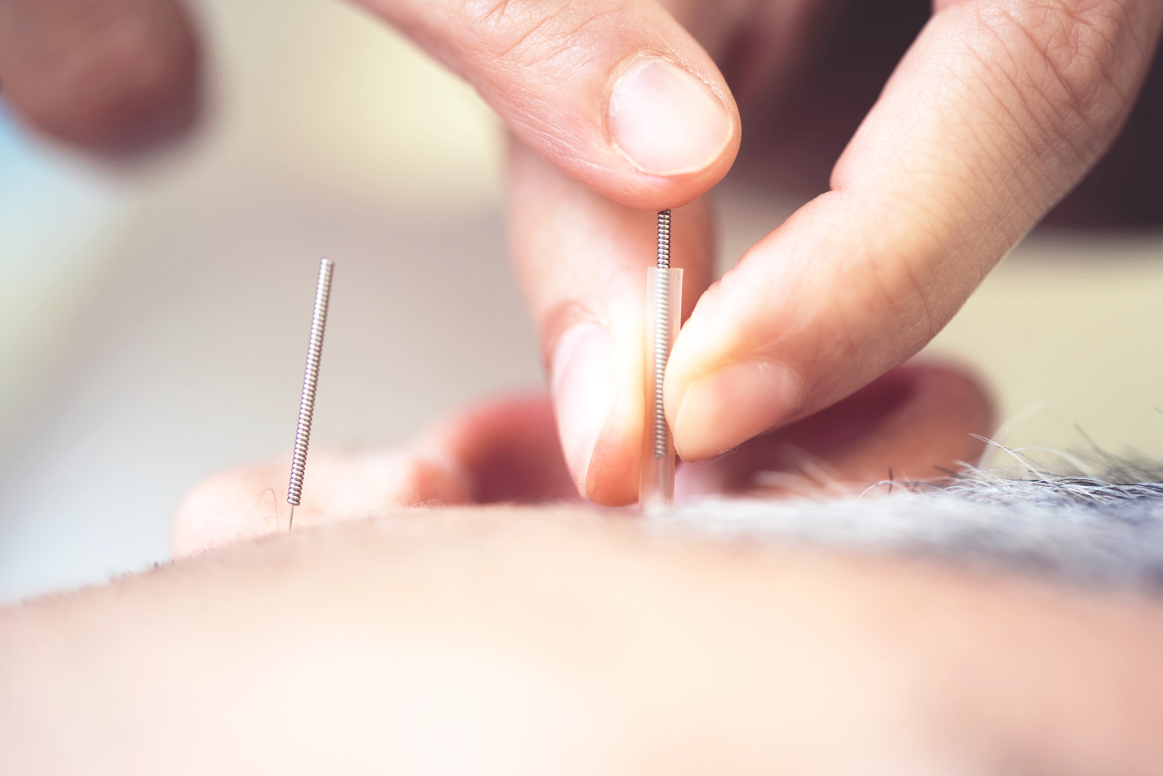 Man on acupuncture